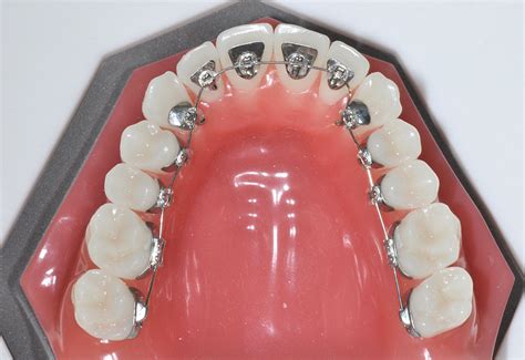 Lingual Braces Manchester How They Differ From Other Systems Blog