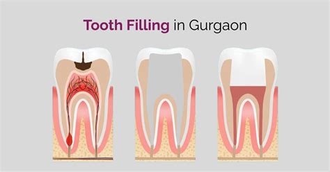 Tooth Fillings In Gurgaon Treatment Types Process And Cost Dantkriti