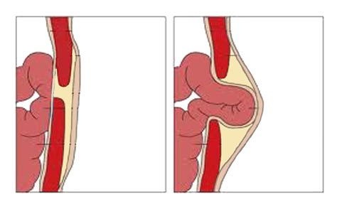 Occasionally, in severe injuries, the muscle. Hernia or Pulled Abdominal Muscle? Know the Difference ...