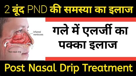Post Nasal Drip Blood Discount Clearance Save 54 Jlcatjgobmx