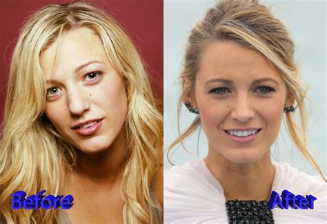 Blake Lively Before And After Nose Job Surgery Nose Job Blake Lively Nose Plastic Surgery