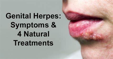 Genital Herpes Symptoms 4 Natural Treatments David Avocado Wolfe