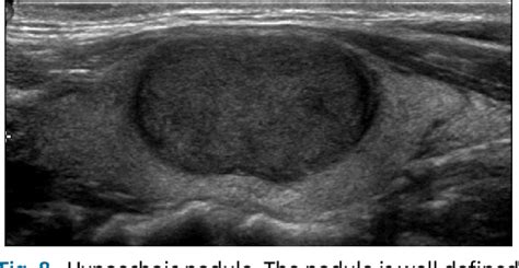 Follicular Carcinoma Ultrasound