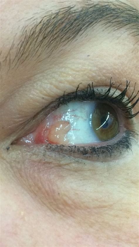 Mom Has An Eye Blister Can Someone Help Identify It Im Kind Of