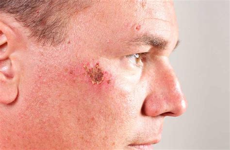 Causes Of Scabs On Face And Fast Treatment Ways Skincarederm