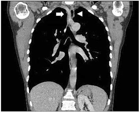 Contrast Neck And Chest Ct Scan Coronal View Showing A Foreign Body