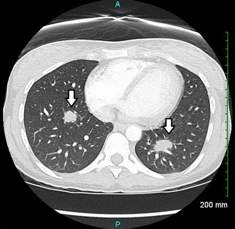 Nodular Pulmonary Sarcoidosis Presenting As Acute Chest Pain Bmj Case