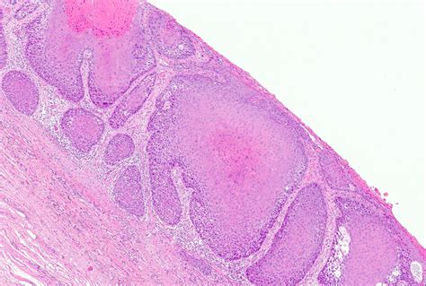 Pathology Outlines Squamous Cell Carcinoma Vulva