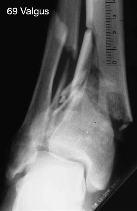Anatomy Of Pilon Fractures Of The Distal Tibia Bone And Joint