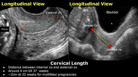 How To Measure Cervical Length On Ultrasound Transabdominal And