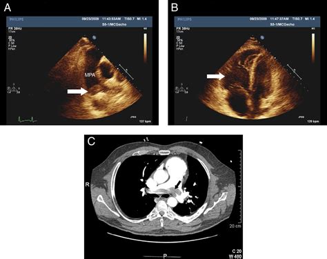 Saddle Pulmonary Embolism Visualized By Transthoracic Echocardiography Journal Of The American