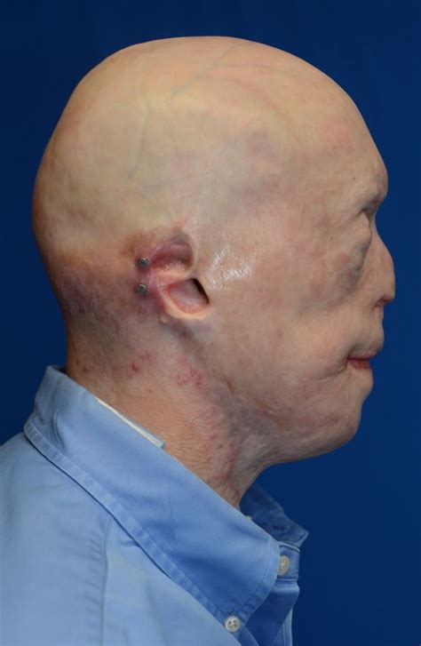 Graphic New Photos Of Face Transplant Show Burn Patients Remarkable