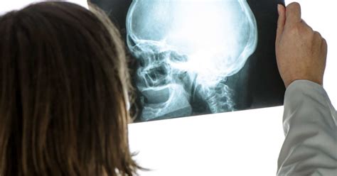 Skull Fracture Types Symptoms And Long Term Effects