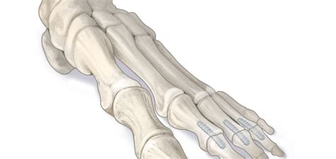 Fda Clears Absorbable Foot And Ankle Pins