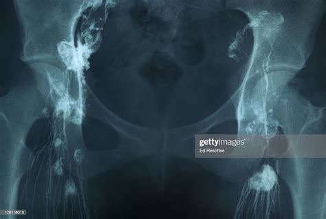 Xray Lymphangiogram Showing Lymph Nodes And Lymphatic Vessels