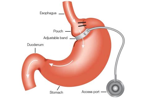 Adjustable Gastric Banding Ds Surgery Dssurgery