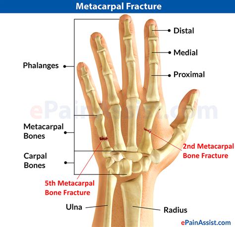 Metacarpal Fracture Or Broken Handcausessymptomstreatmentexercises
