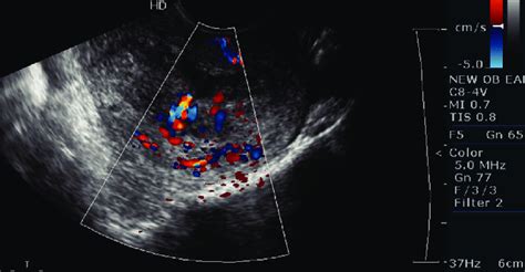 transvaginal ultrasound color doppler showing increased vascularity my xxx hot girl