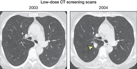 Computed Tomography Screening For Lung Cancer Cancer