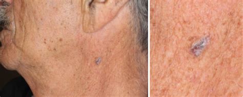 Pigmented Bcc Of Left Neck Skin Cancer And Reconstructive Surgery Center