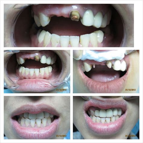 Harga braces meningkat saban tahun. Klinik Pergigian in Ipoh, Malaysia - Read 6 Reviews