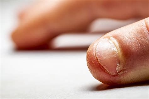 The Habit Of Nail Biting Could Have Many More Consequences