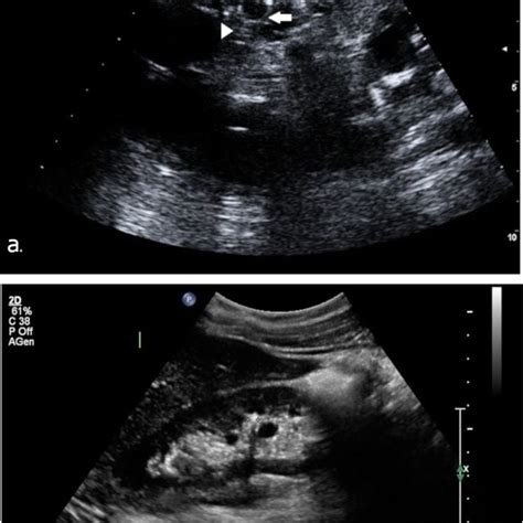 Pdf Ultrasound To Address Medullary Sponge Kidney A Retrospective Study