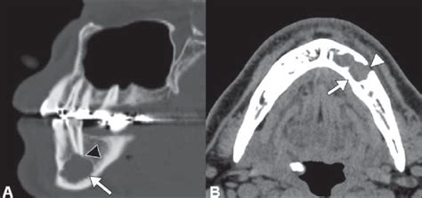 Year Old Woman With Odontogenic Myxoma A And B Sagittal Bone
