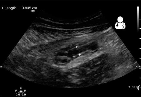 Human X Ray Of Pregnant Woman Sondra Murry