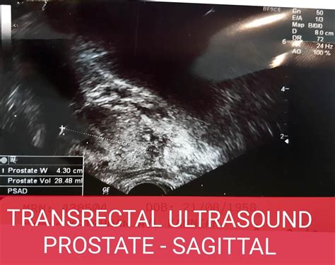 Transrectal Ultrasonography Of The Prostate Urology Malaysia