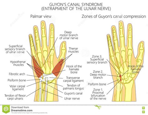 Entrapment Of The Ulnar Nerve In The Wrist In The Guyons Canal 2 Stock
