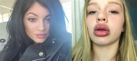 when the kylie jenner lip transformation challenge goes wrong epic fails