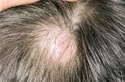Sebaceous Cyst On The Scalp Stock Image C0029582 Science Photo Library