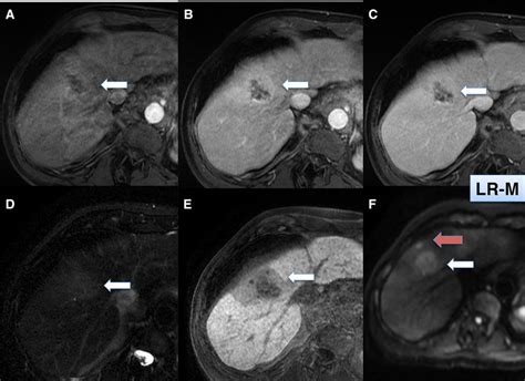 A 69 Year Old Male With Hcv Liver Cirrhosis Presents With 23 Cm Download Scientific Diagram