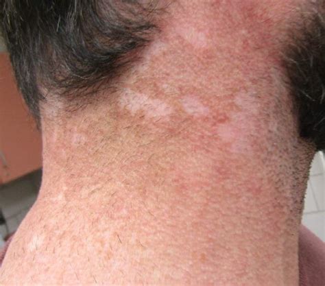 Dermdx Hypopigmented Rash On Neck Clinical Advisor