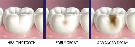 The resulting hole is called a cavity. Tooth Cavities - Preventive Care & Treatment