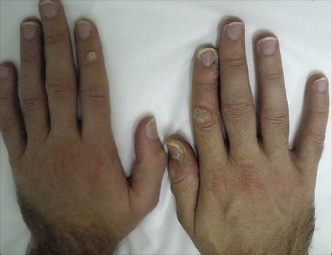 Treatment of recalcitrant warts with the carbon dioxide laser using an. Recalcitrant Cutaneous Warts Treated With Recombinant ...