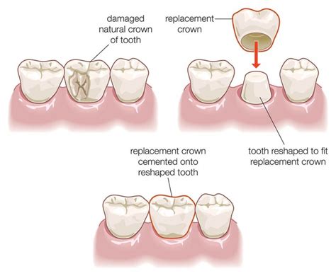 Dental Crowns Explained ⋆ Dental House