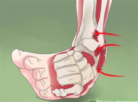 Ankle Sprain Chiropractic Treatment Sprained Ankle Pain Relief