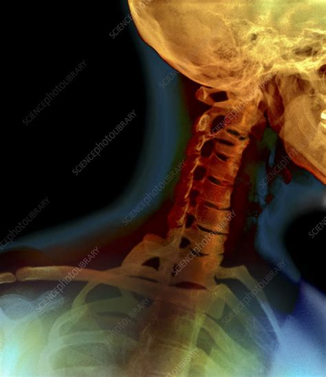 Osteoarthritis Of The Neck X Ray Stock Image M1100685 Science