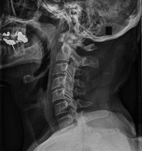 C Spine X Ray Interpretation