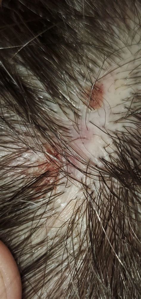 Help Sores Have Appeared On My Scalp And Im Not Sure What Is The