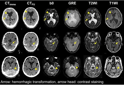 Mr Imaging For Differentiating Contrast Staining From Hemorrhagic