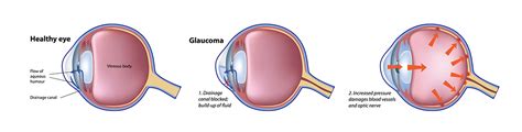 Glaucoma Dr Brighu Swamy Ophthalmic Surgeon