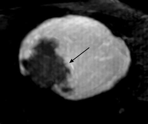small coil mri of the nipple areola complex and retroareolar breast