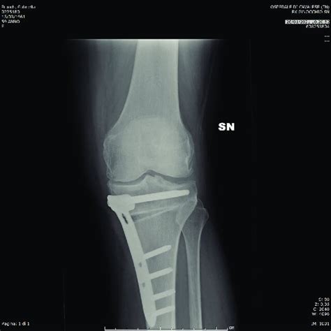 The Radiographic Follow Up After Six Months Shows The Healing Of The
