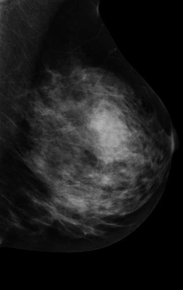 Simple Cyst On Contrast Mammogram Image