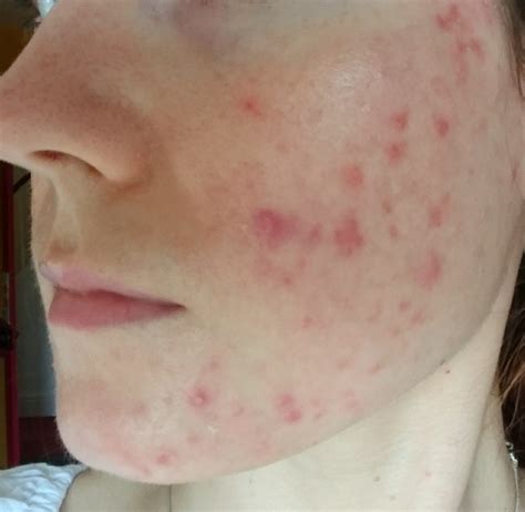 Roaccutane On The Nhs A Uk Blog Page 2 Accutane Isotretinoin