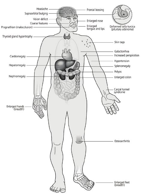 acromegaly diagram