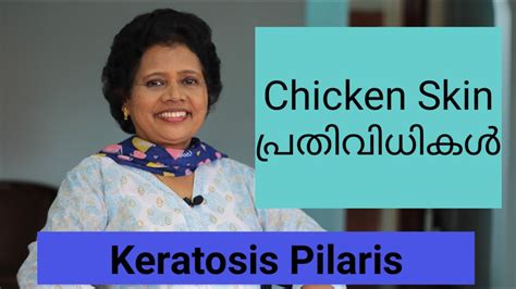 Chicken Skin Remedies Dr Lizy K Vaidian Youtube